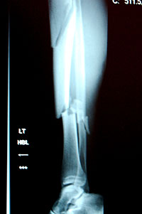 Roberts bones 2006